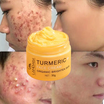 Turmeric Anti Wrinkle Anti Pimple Acne Treatment Cream For Woman Skin Care